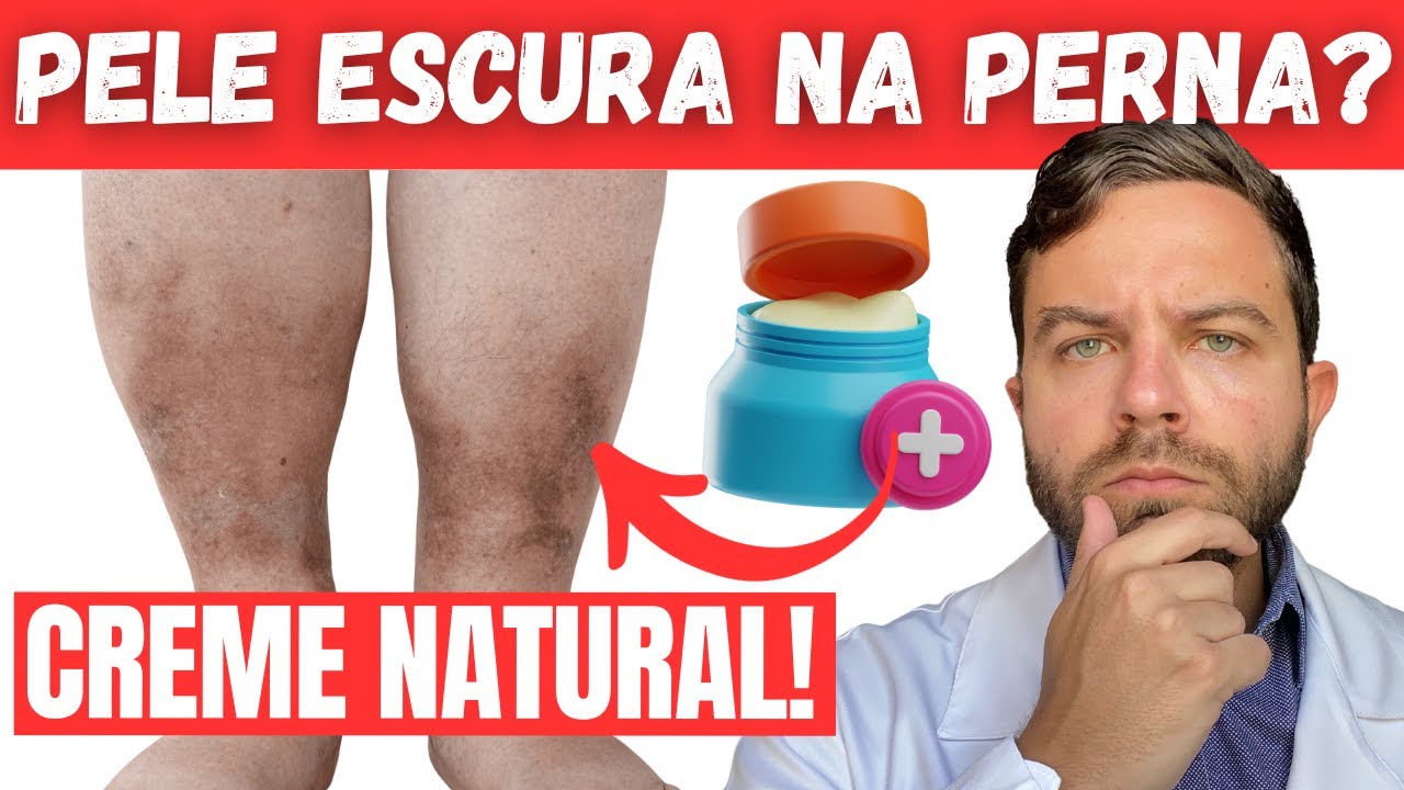 Como TIRAR MANCHAS ESCURAS de MÁ CIRCULAÇÃO das PERNAS?