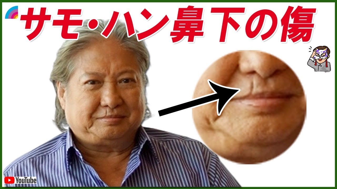 【サモ・ハン】鼻下の傷！