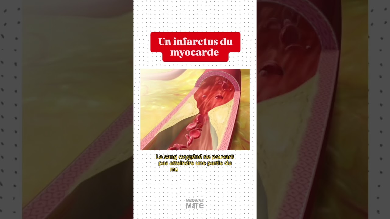 L'infarctus du myocarde 