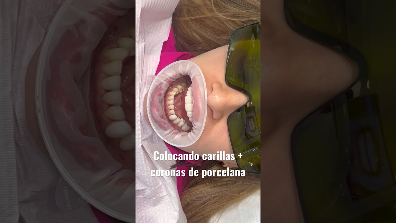 Renovando sonrisas #carillasdentales #dise&ntilde;odesonrisa #carillas #carillasceramicas