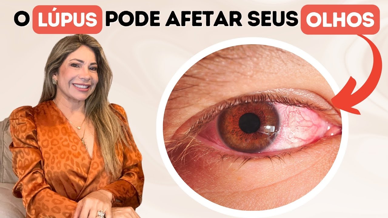 L&uacute;pus Afeta os Olhos? Tudo Que Voc&ecirc; Precisa Saber Sobre os Impactos&nbsp;Visuais!