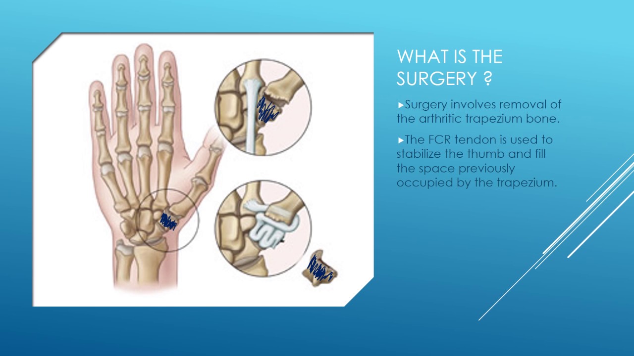 Basal Thumb Arthritis Explained by Dr Anzarut