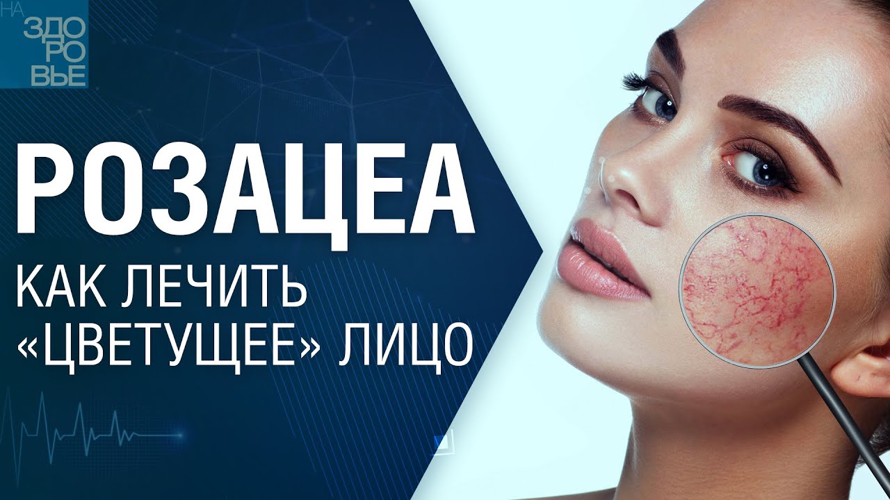 Розацеа. Как лечить «цветущее» лицо. На здоровье 28.12.2024