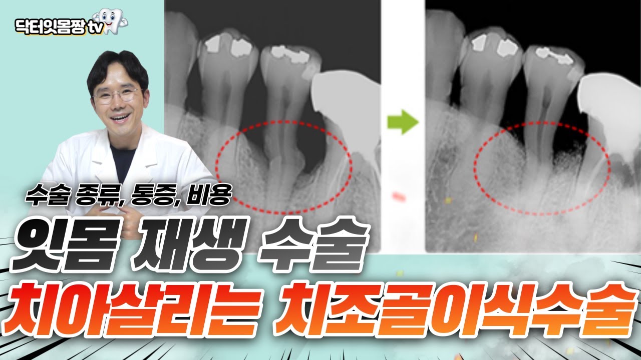 치아 살리는 뼈이식? 잇몸재생술? 💪 조직유도재생술 완전해부