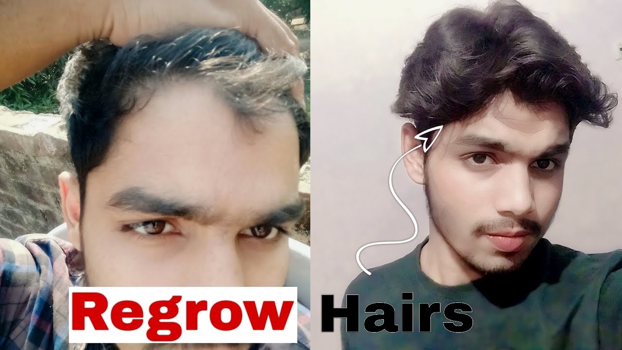 5 Ways to STOP hairloss permenantly | How to Stop hairfall and regrow hairs