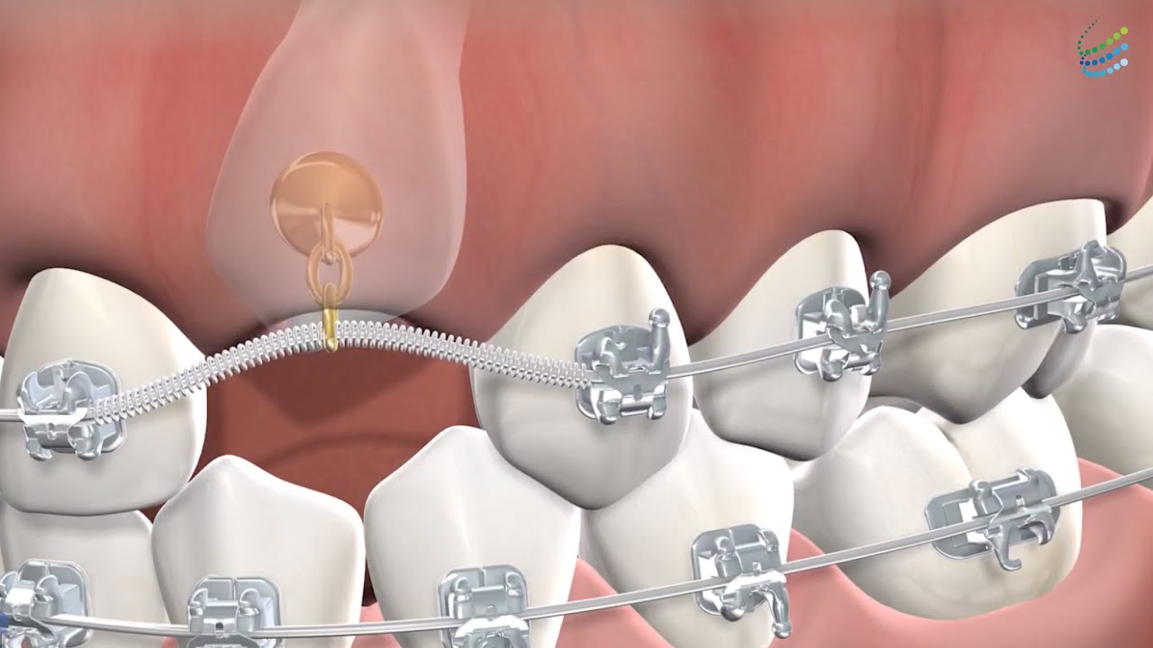 Expose and Bond in at Oral Surgery Services, Metairie, LA