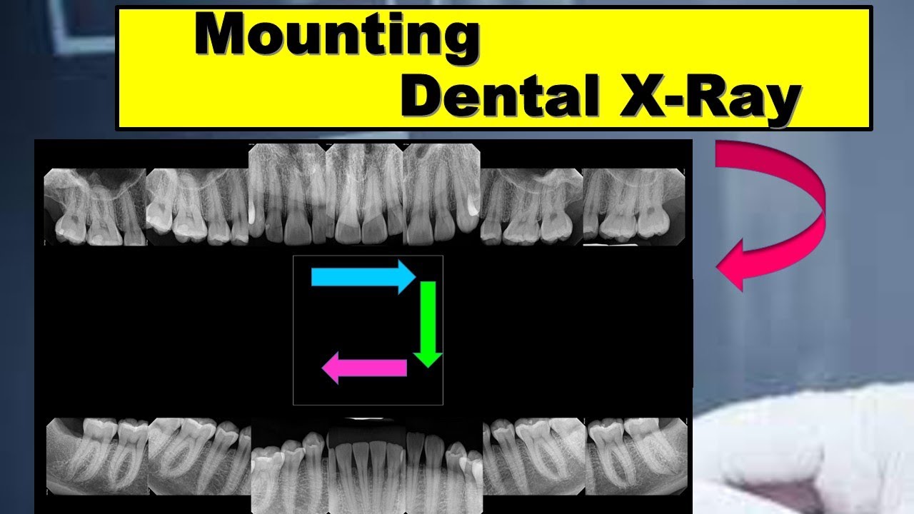 Dental X-Ray Full Mouth Mounting (FMX)