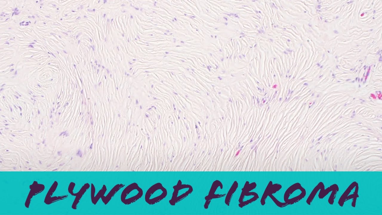 Sclerotic fibroma 