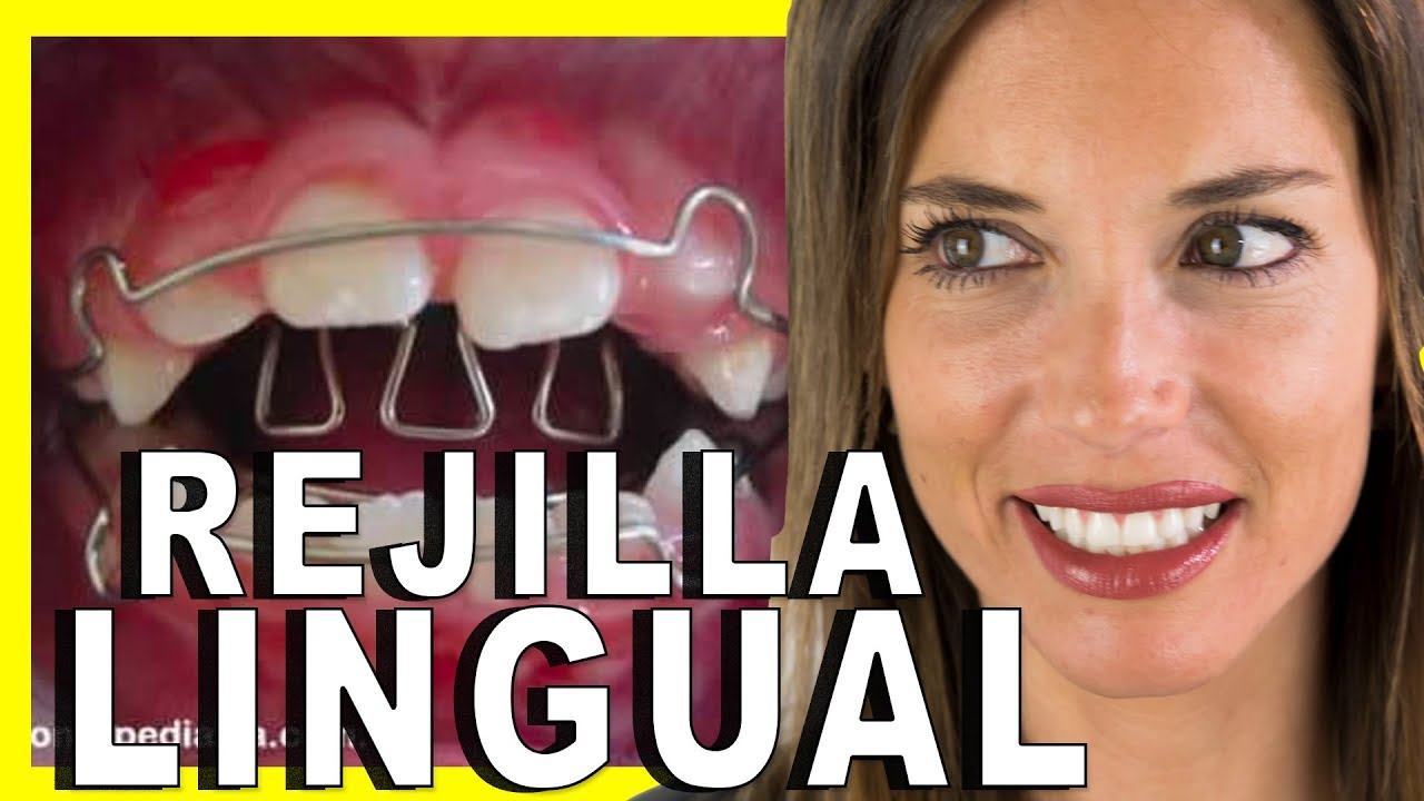 🔶𝐓𝐑𝐀𝐌𝐏𝐀 𝐋𝐈𝐍𝐆𝐔𝐀𝐋 ortodoncia🔶Como corregir la DEGLUCION ATIPICA 🤷‍♀️SOLUCION