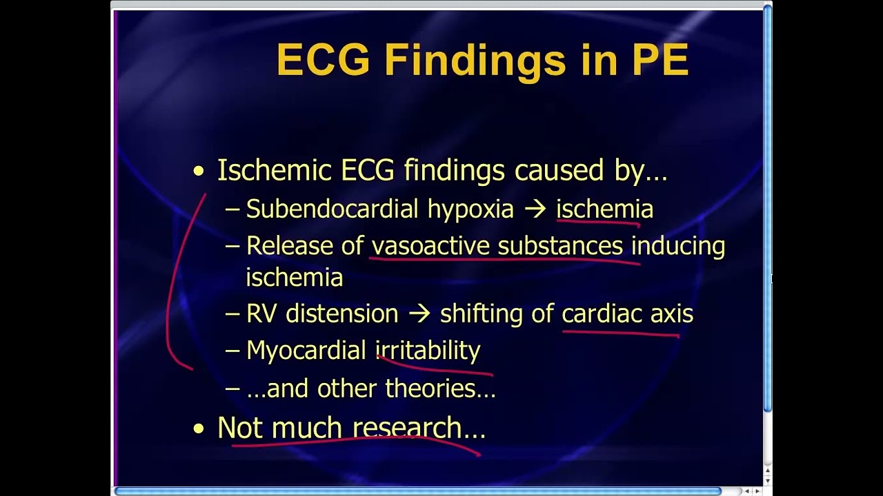Amal Mattu's ECG Case of the Week_ May 19, 2014