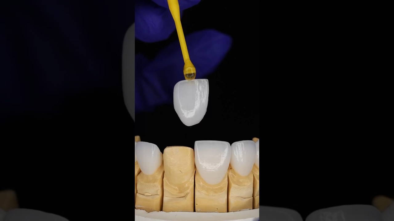 Cost of Porcelain veneers 🦷💰 #veneers #dentalveneers #costofveneers #priceofveneers #veneerprice