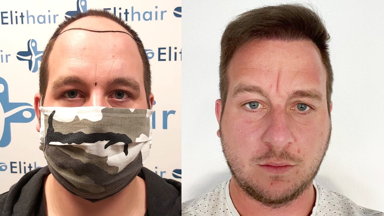 Greffe de cheveux avant et après de Maik - Résultats mois par mois #3 | Elithair