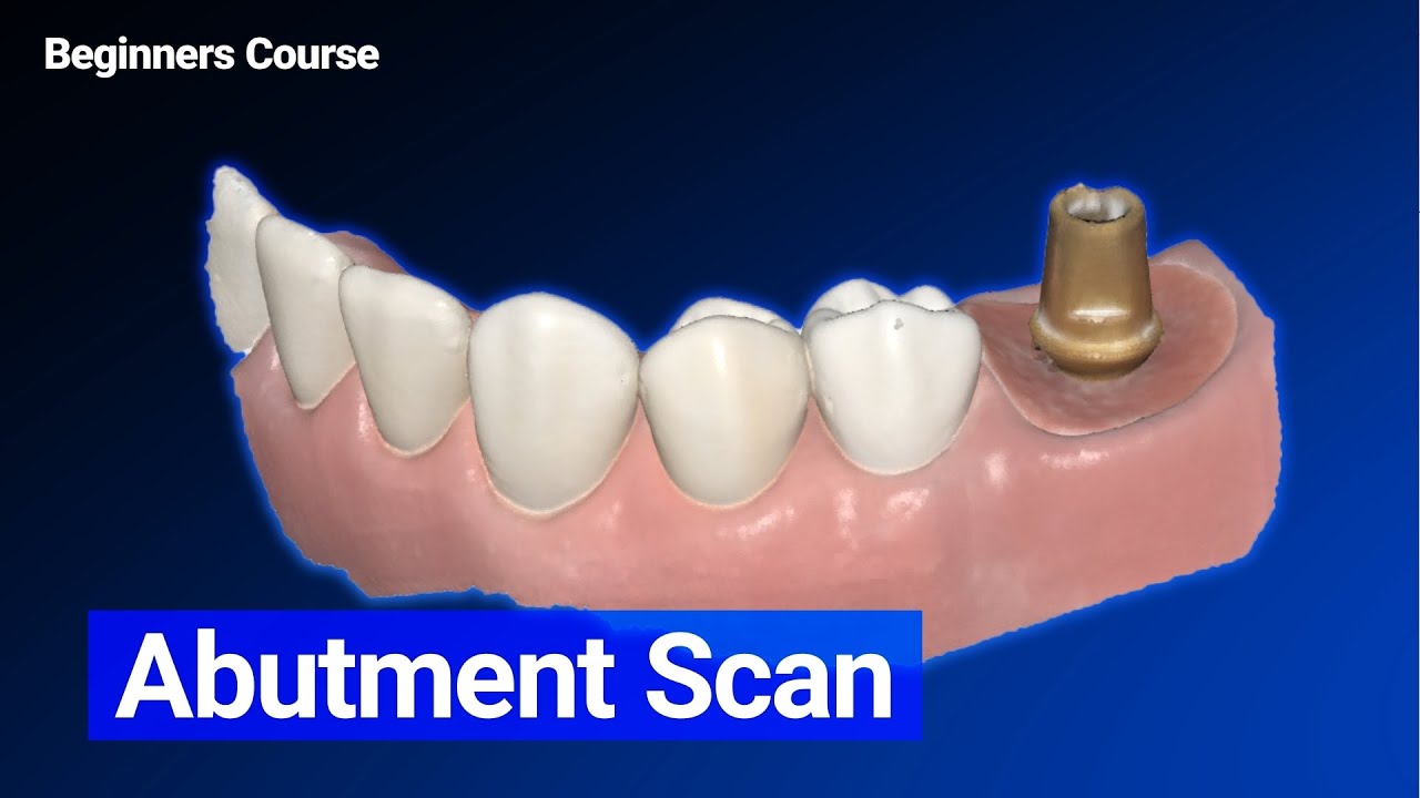 Abutment Scan