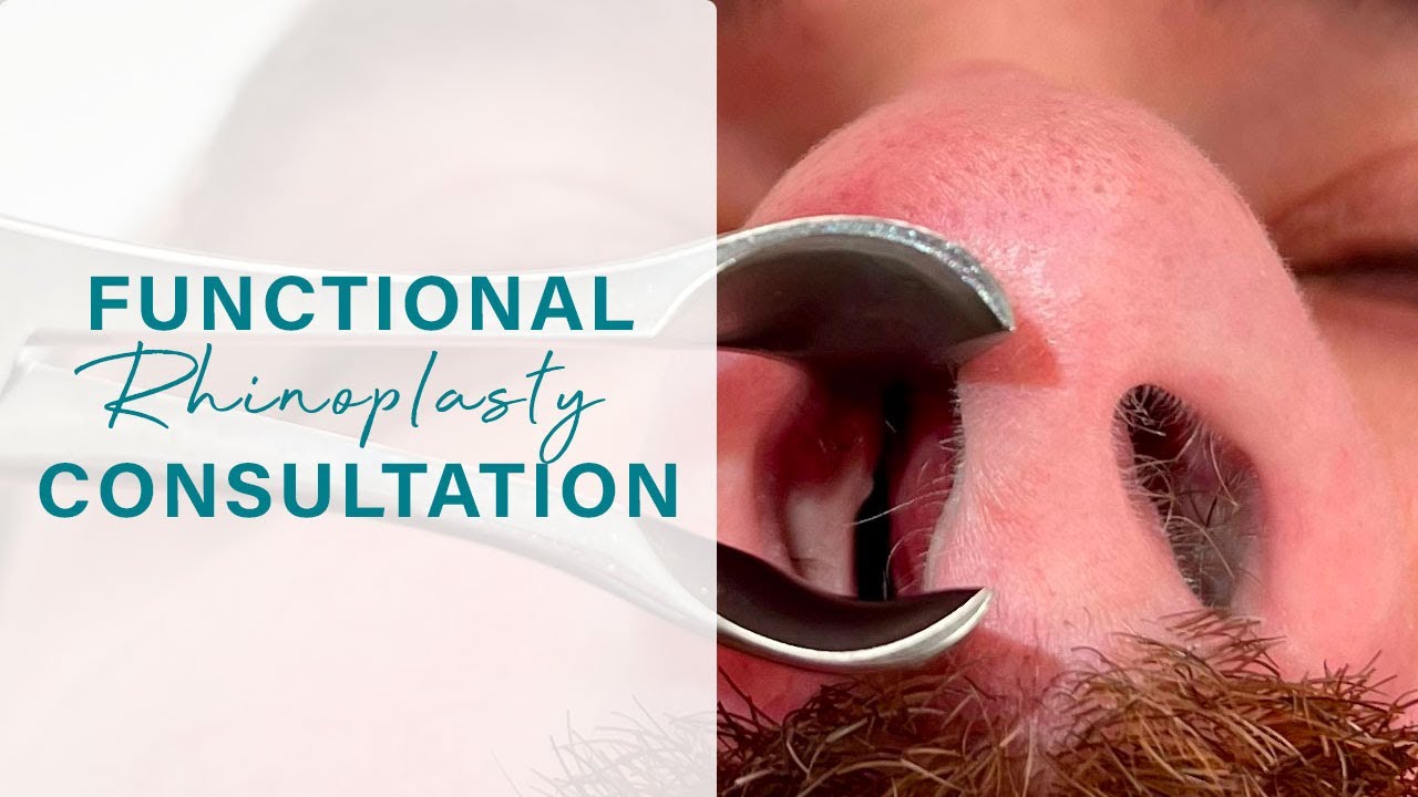Functional Rhinoplasty Consultation | Collapsed Nasal Airway