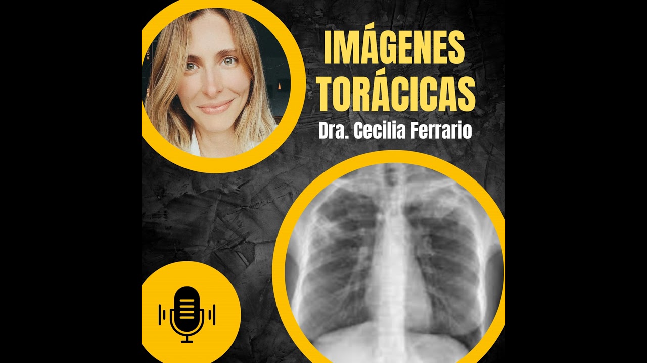 Absceso pulmonar y neumonía necrotizante por TC