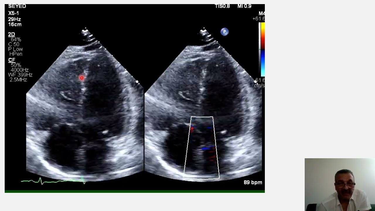McConnell sign, RV strain- pulmonary embolism vs. RV infarction, pulmonary hypertension