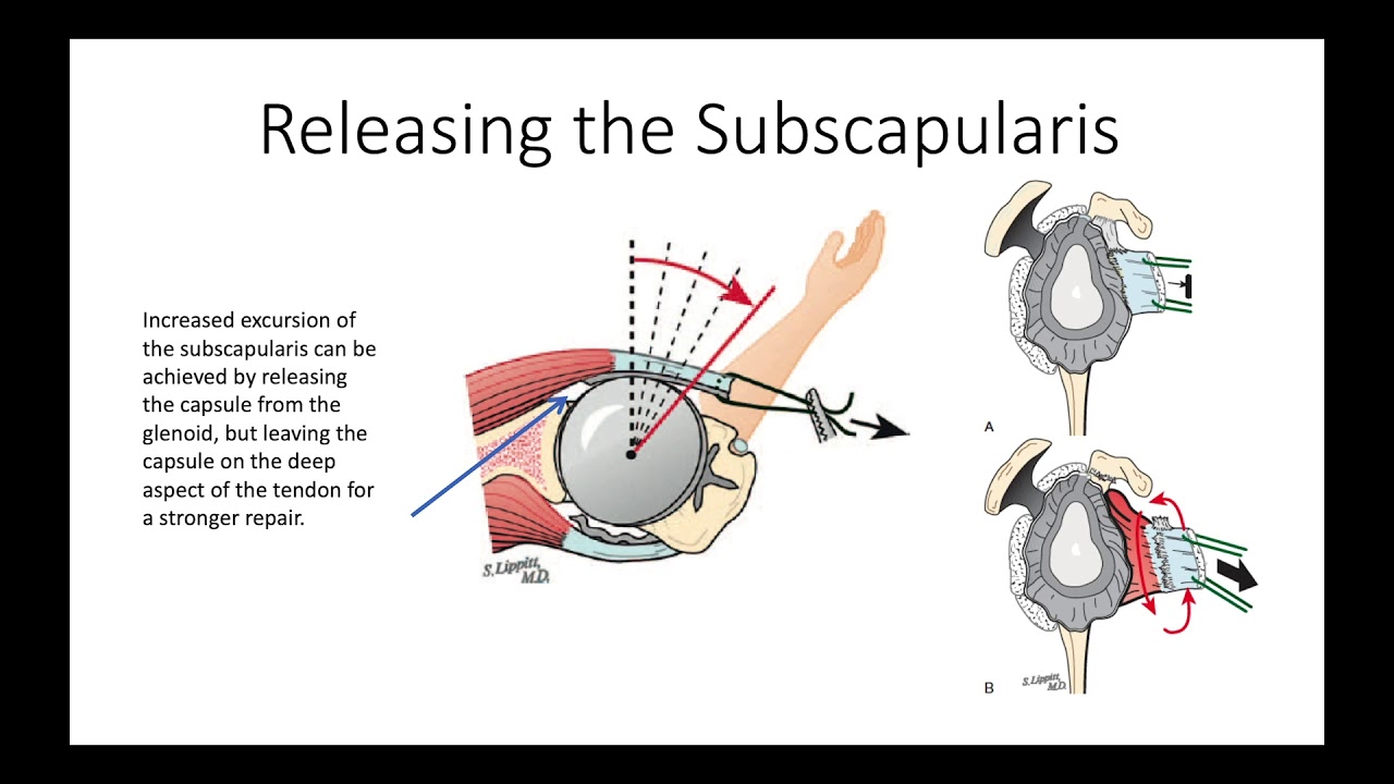 How To Do a Total Shoulder #1: Patient Positioning and Surgical Approach