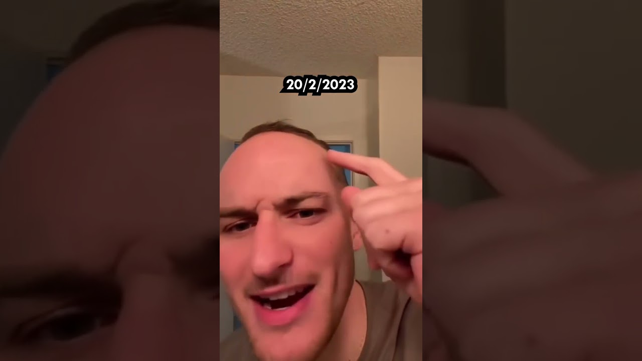 &iquest;Es Imposible Recuperar El Pelo?