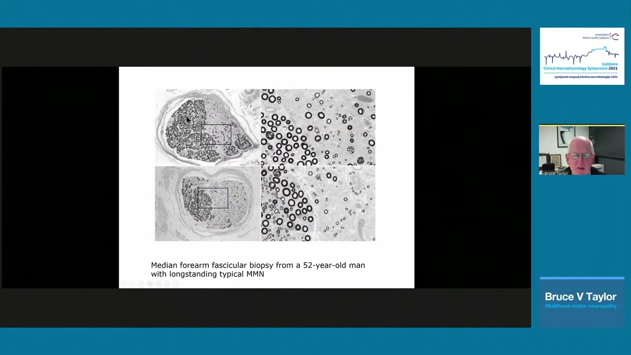 Bruce V. Taylor: Multifocal motor neuropathy
