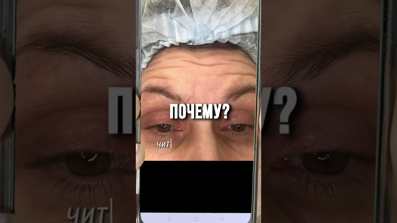 НИКОГДА НЕ ДЕЛАЙТЕ БОТОКС! Это я как врач косметолог вам говорю!  #ботокс #botox