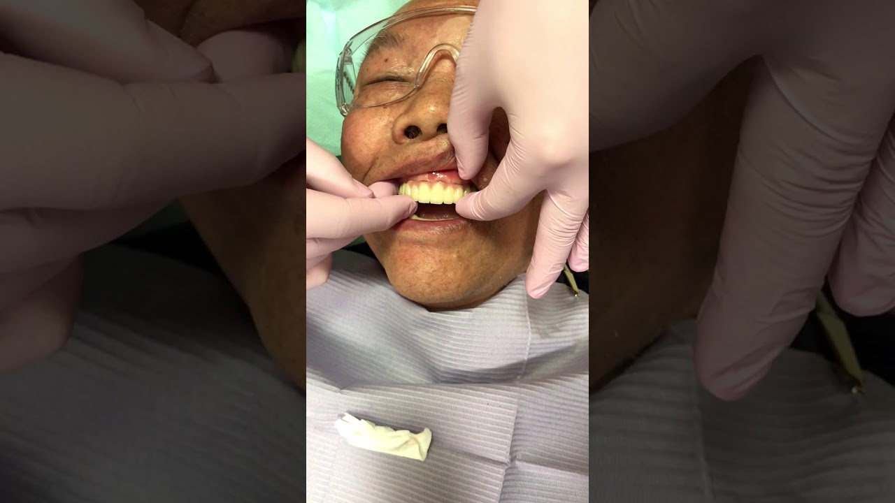 upper all on 8 - all on four dental implant alternative - #10