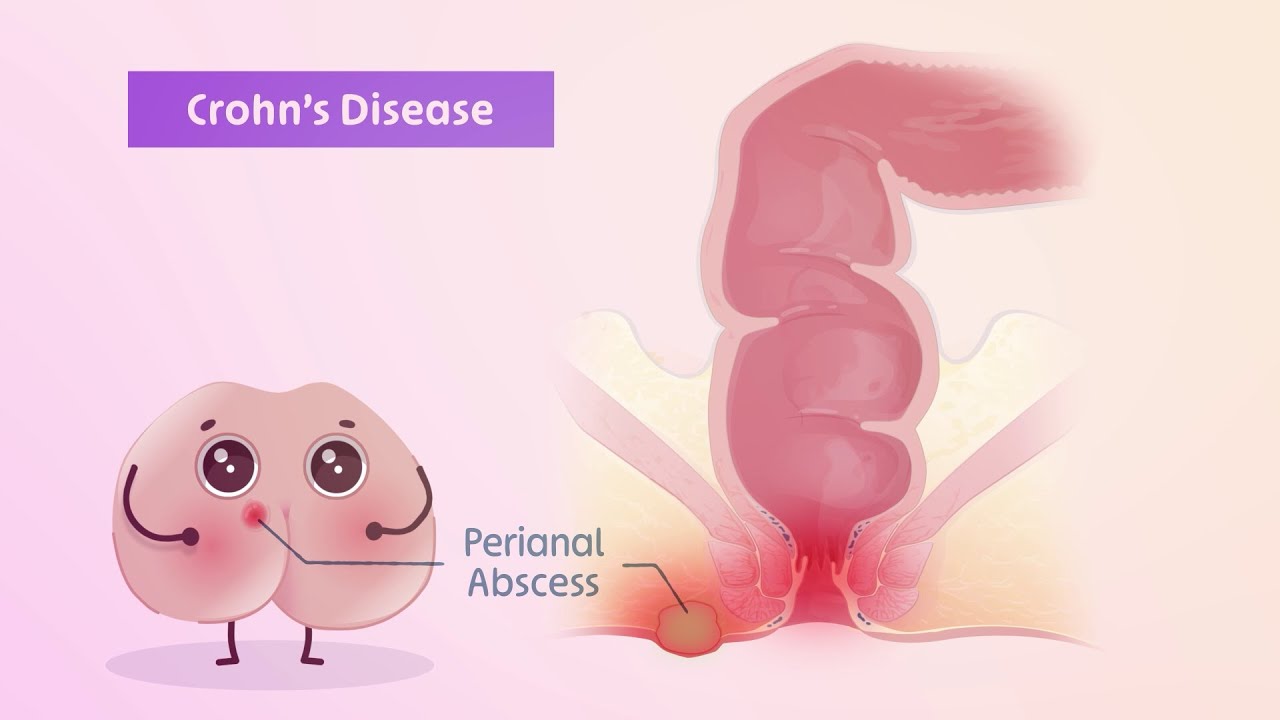 Perianal fistulas in Crohn's disease patients | TVASurg