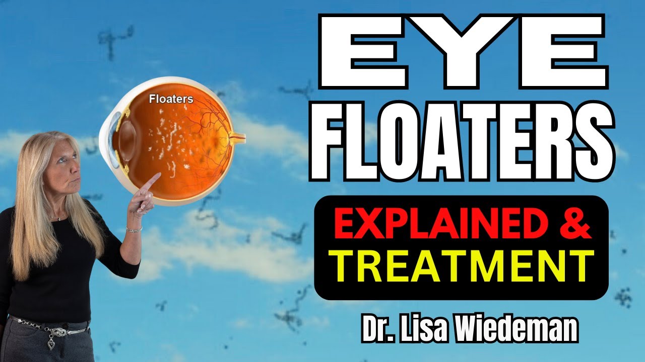 FLOATERS - What you need to know