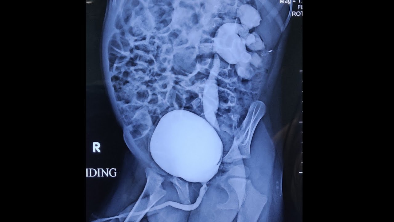 Lap extravesical reimplantation by Dr. Ramesh Babu