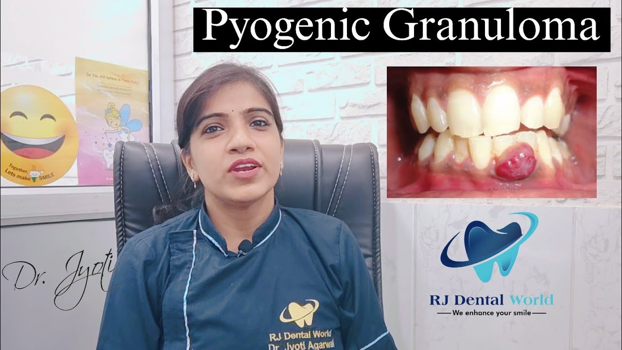 pyogenic Granuloma