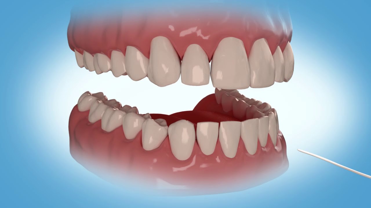 3D Dental Retainers