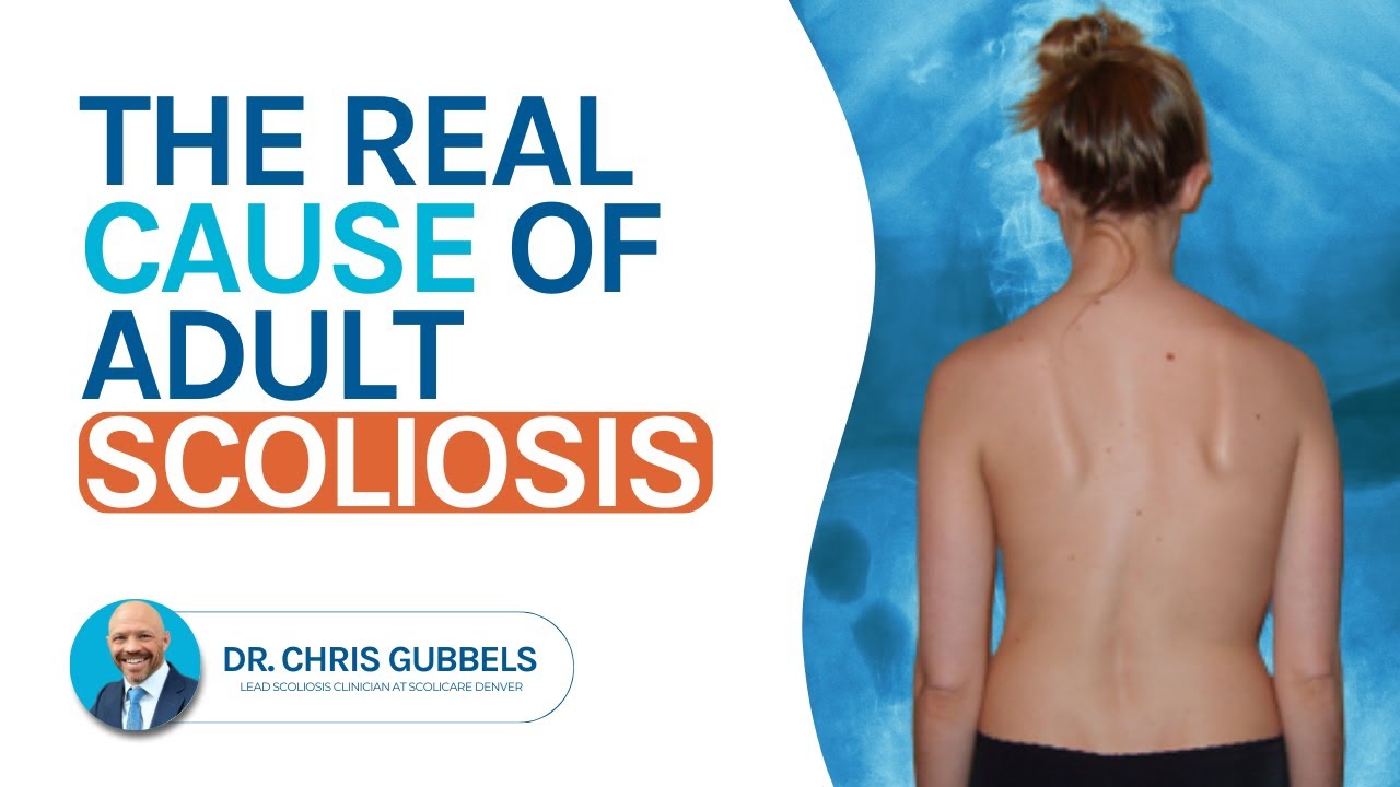 What Causes Adult Scoliosis?