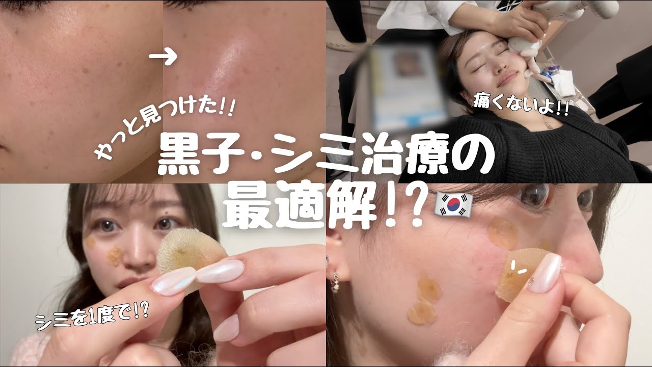 【韓国美容】長年悩んできた黒子の治療跡の色素沈着...遂にさようなら!!! / シミ治療・黒子治療をお考えの方は是非みてください🥺 / 毛穴が一気に小さくなった肌治療も✨