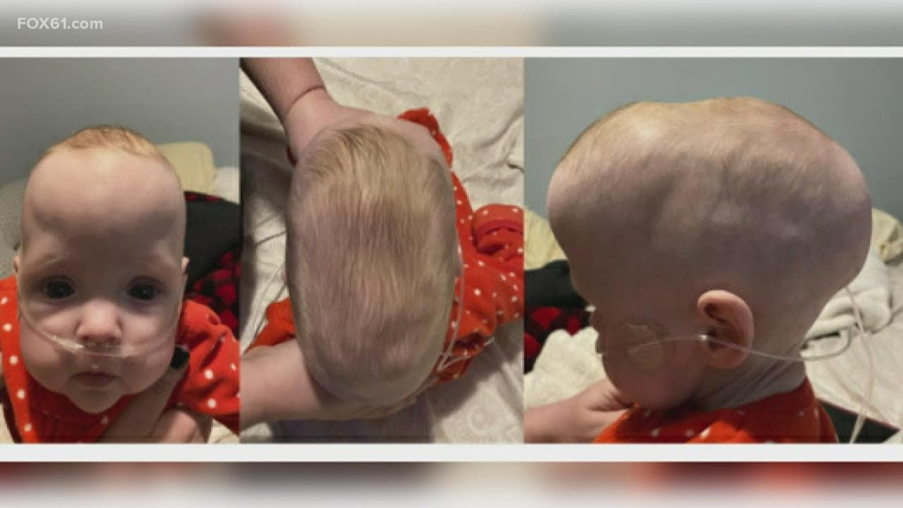 Family First: App to diagnose Craniosynostosis