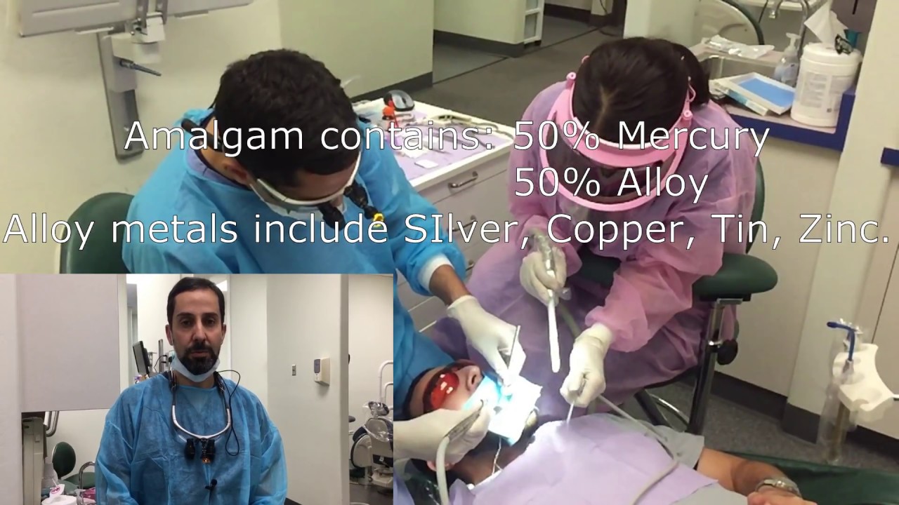 Replacing old Amalgam fillings, What are the options? (amalgam video2)