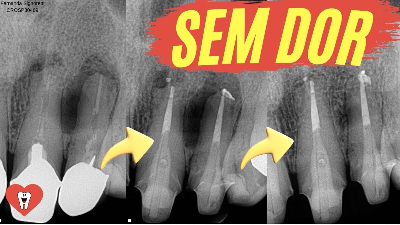 ENDODONTIA: RETRATAMENTO PASSO A PASSO [DETALHADO]- Endolovers