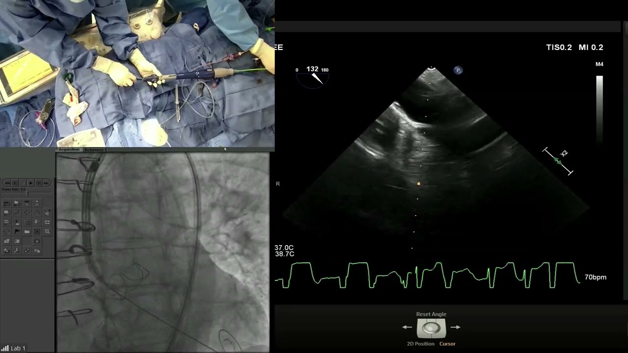 LIVE CASE 6   VALVE IN VALVE TAVR