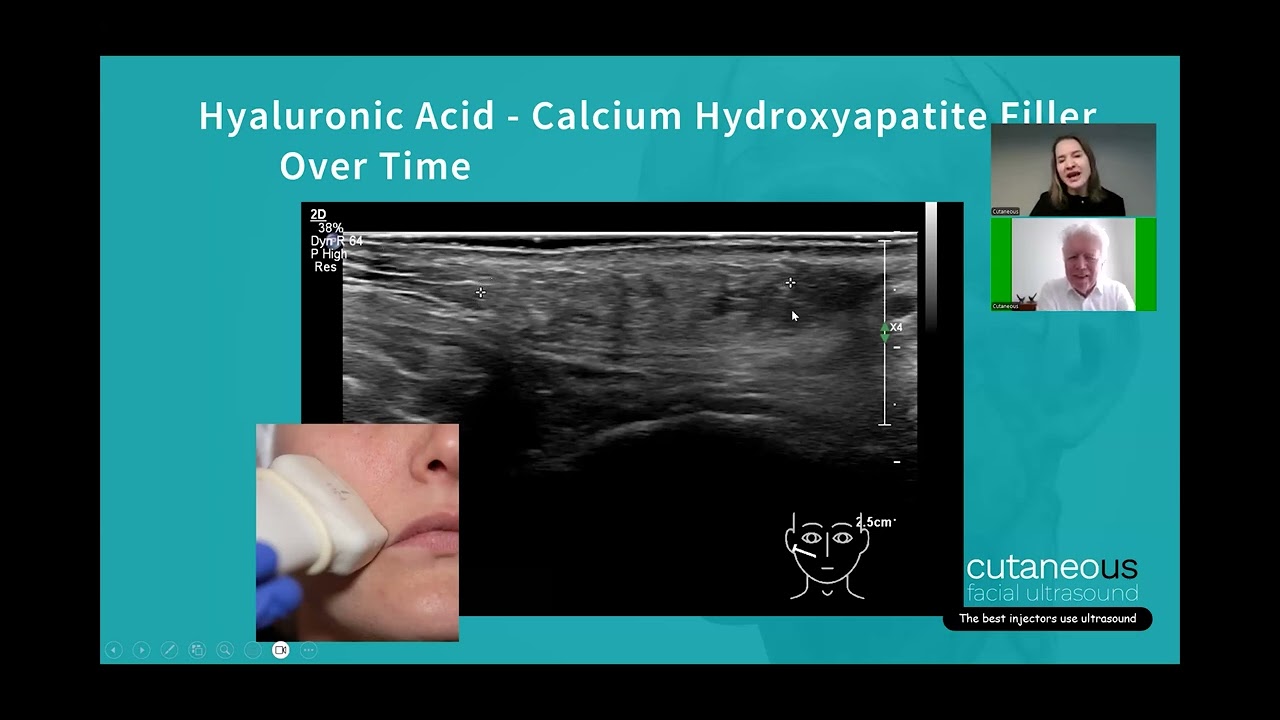 Mixing HA & CaHA Fillers: What Are the Benefits and Risks?