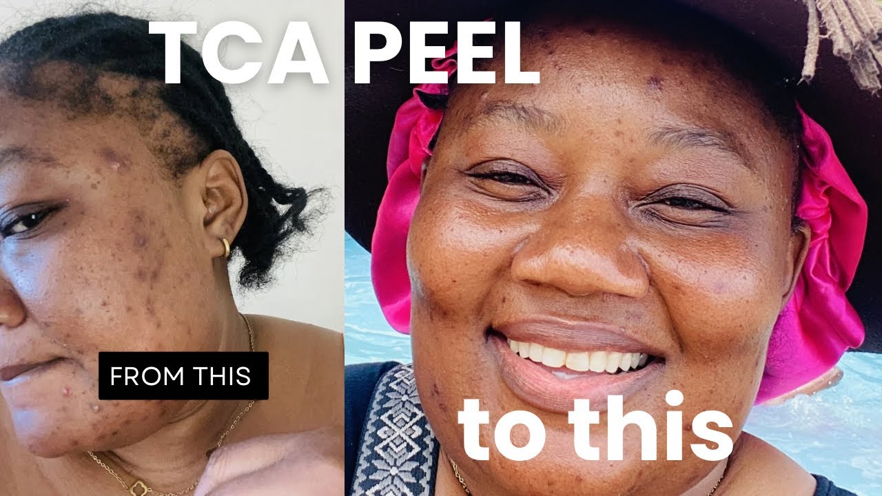 TCA chemical peel dark spot elimination journey #chemicalpeeling #selfcare #namibiancontentcreator 