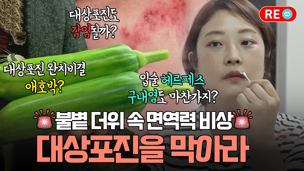 [바른 리플레이🔁] 입술 물집, 온몸에 수포, 염증의 대상포진! 면역력 관리로 대상포진 완치법!