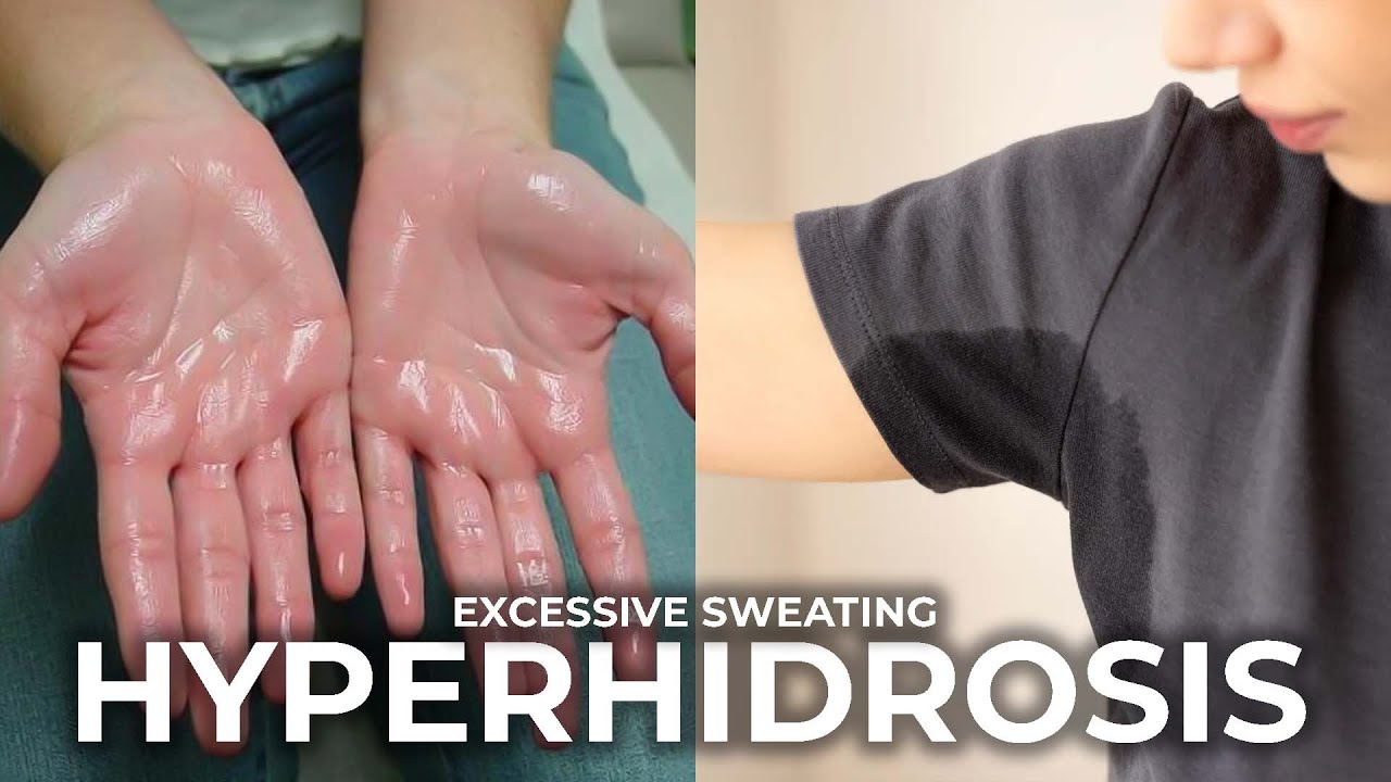 Hyperhidrosis | Causes, Types, and Treatment Options for Excessive Sweating