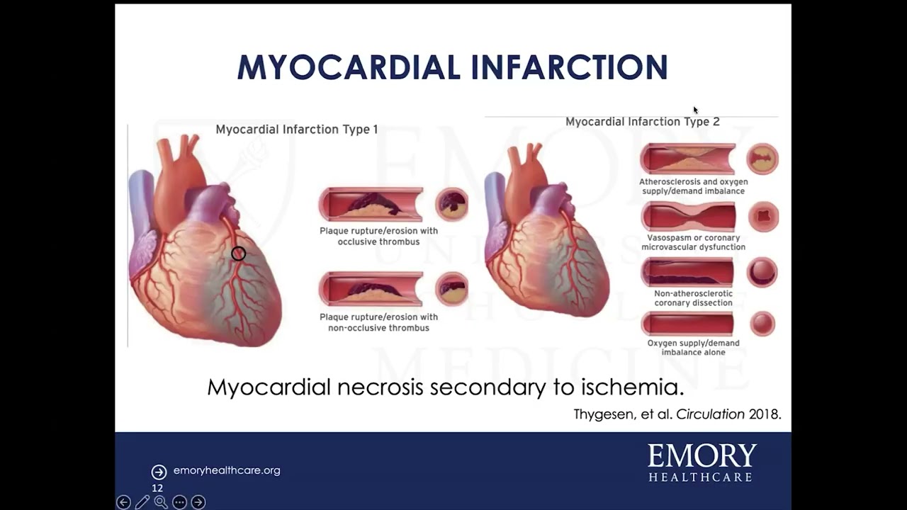 Ischemic or Non-Ischemic Injury? Making Sense of Troponin Elevation at the Bedside
