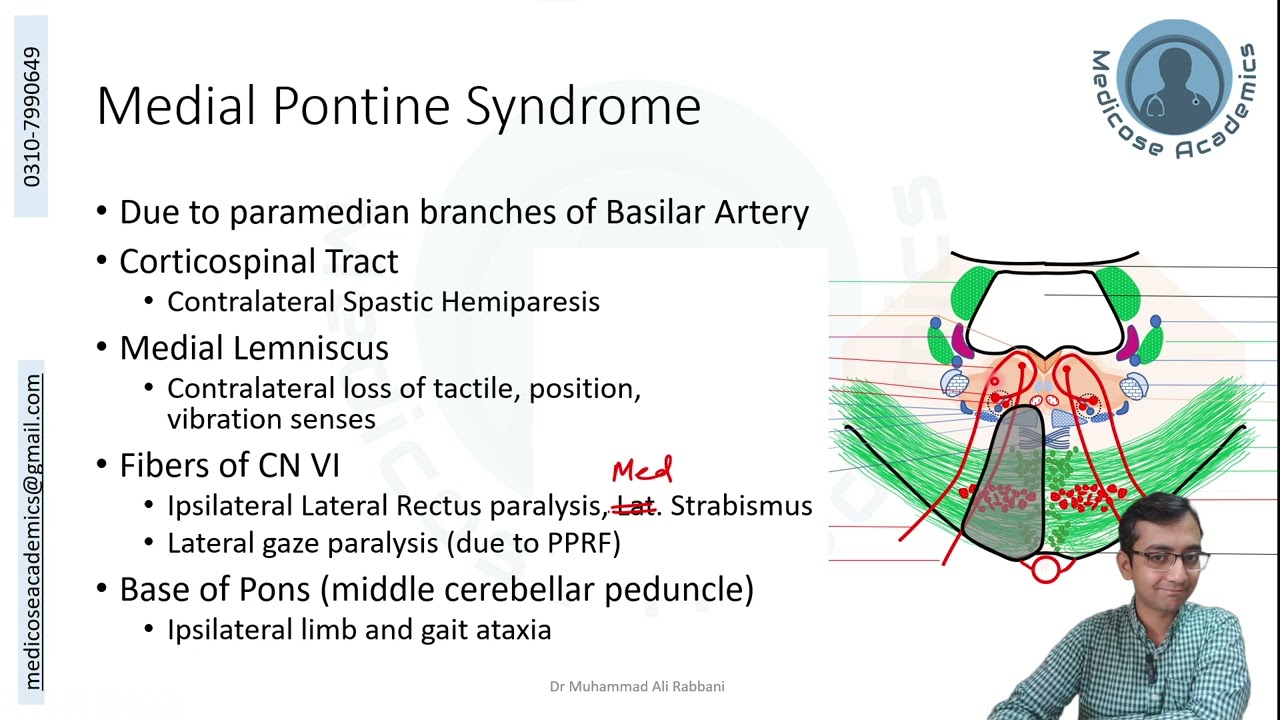 Lesions of Pons