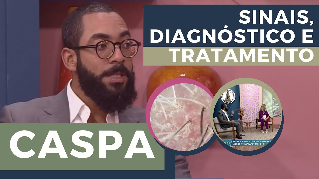 COMO EVITAR E ACABAR COM A CASPA | Dr. João Gabriel Fernandes