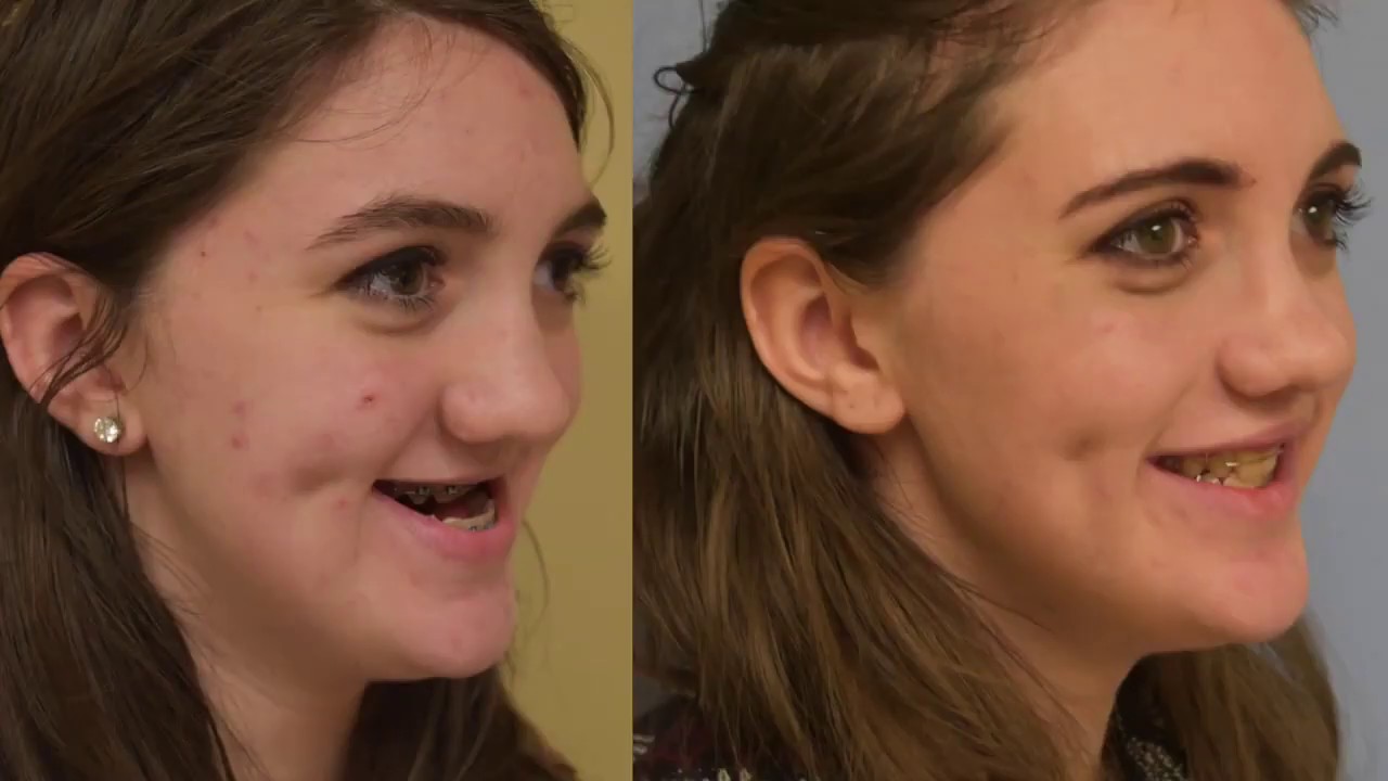 Fixing a Cleft Palate with Craniofacial Surgery - The Science of Healing CLIP