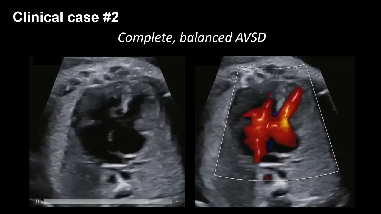 2025 Fetal Echocardiography: Normal and Abnormal Hearts