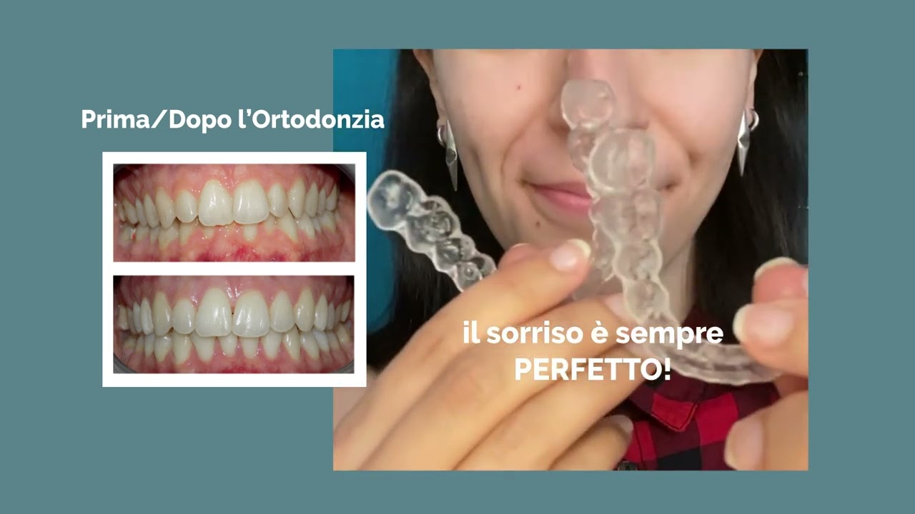 Le contenzioni dopo l'ortodonzia: il nostro caso!