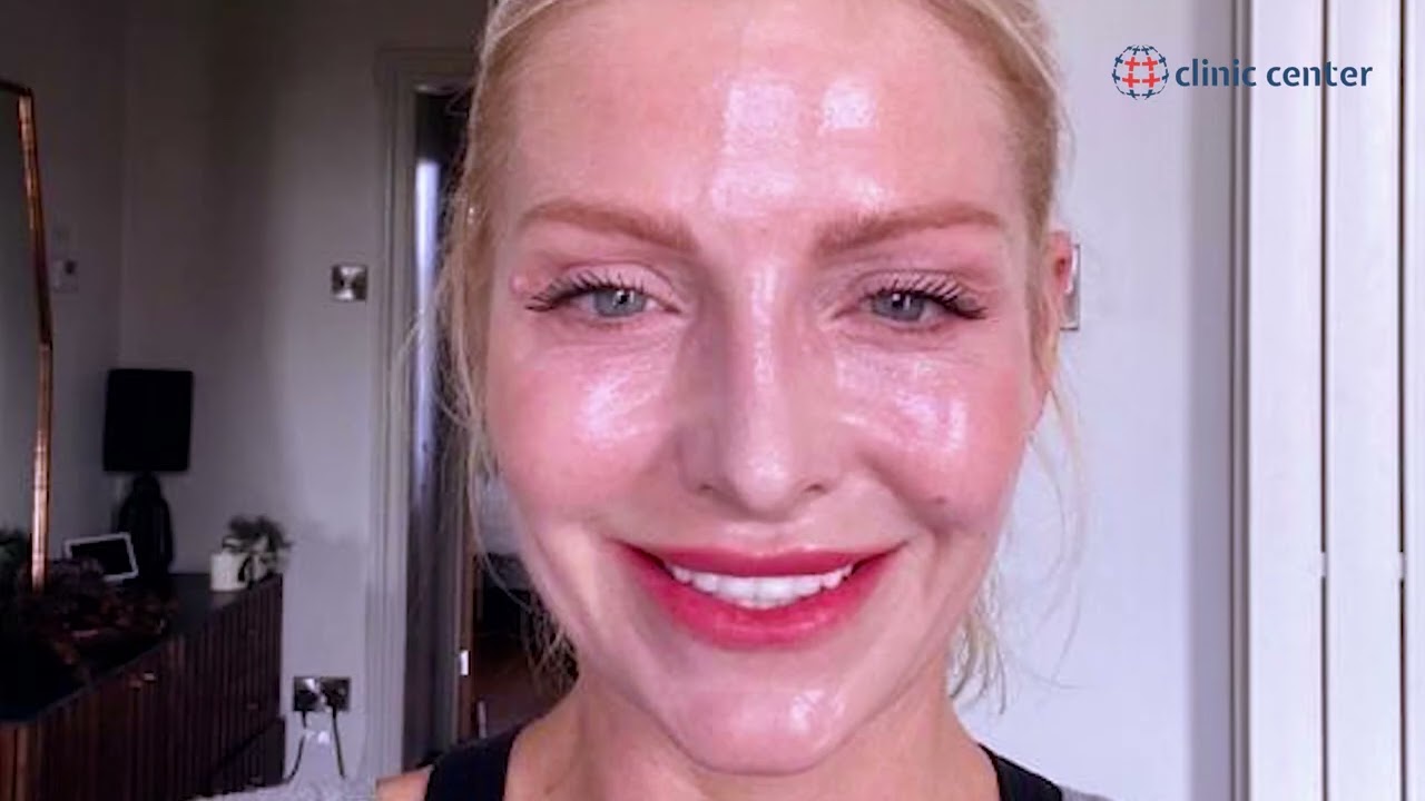 Face Lift & Eyelid in Turkey I Rebecca's Medical Journey I Clinic Center Turkey
