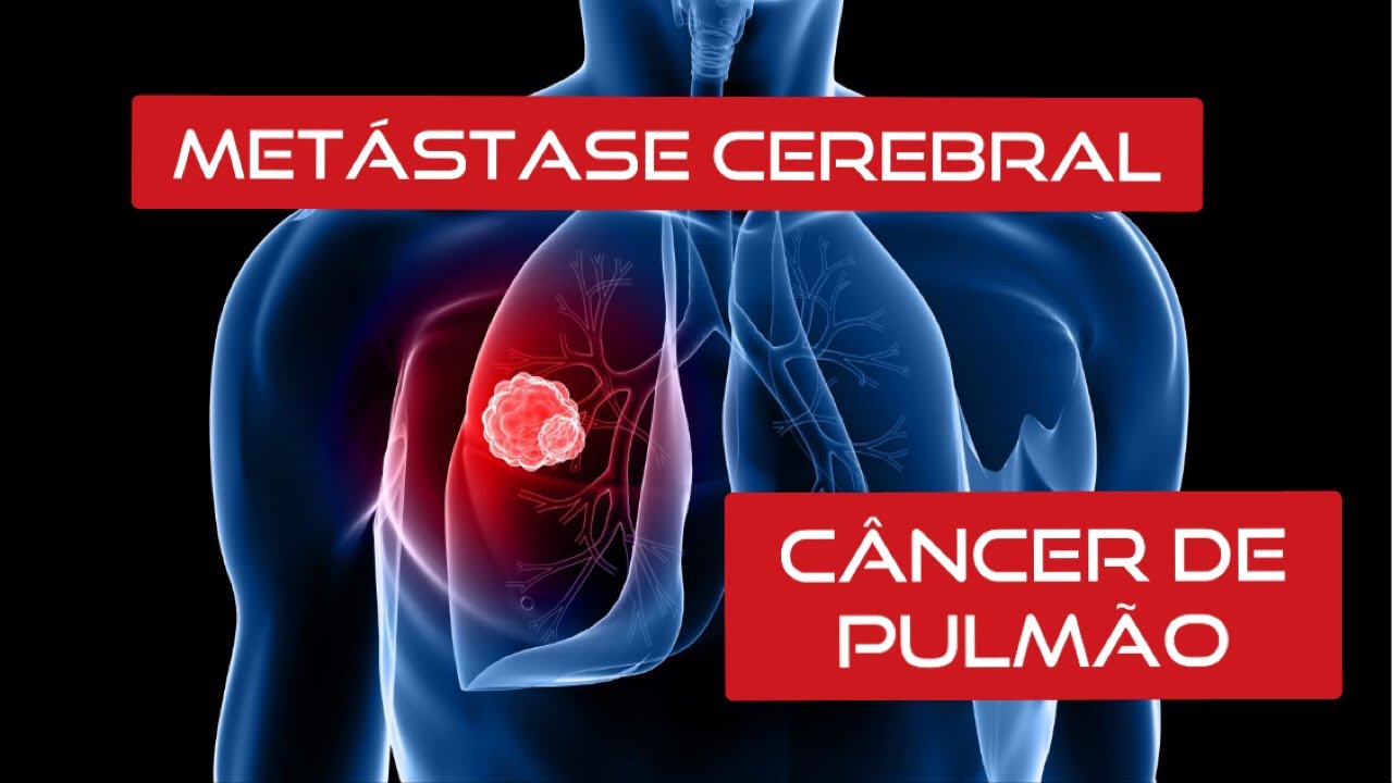 Câncer de Pulmão: Metástase Cerebral