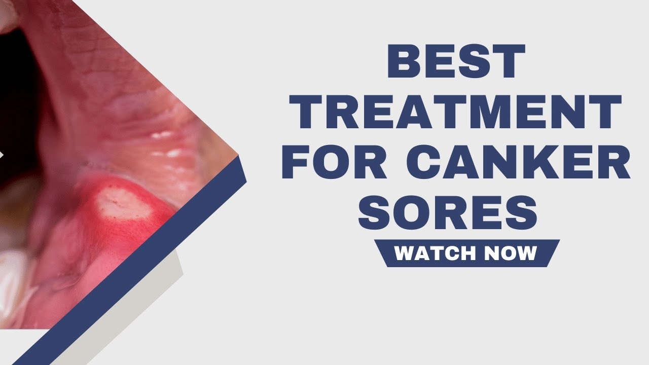 Best Treatment for Canker Sores To Try at Home