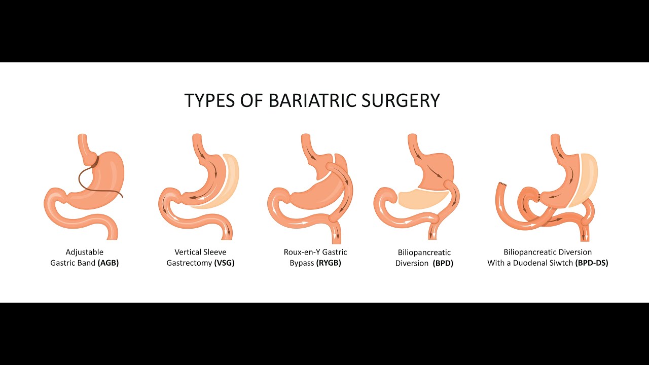 chirurgie obésité: présentation par le Dr Dandrifosse